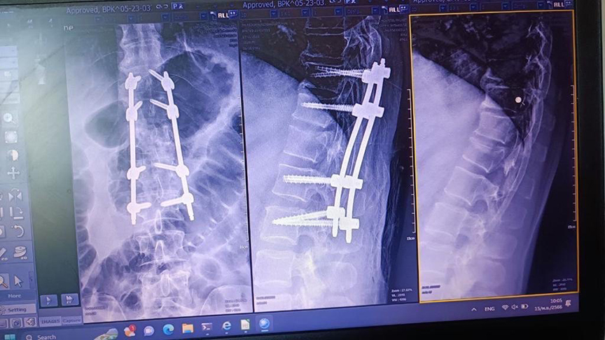 Пострадавший россиянин предъявляет рентгеновский снимок, показывающий, что два позвонка повреждены и требовали срочной операции